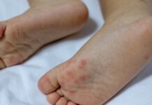 Síndrome Mão-Pé-Boca: SES-AM esclarece principais conceitos da doença viral