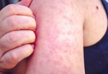 Distrito Federal registra primeiro caso de sarampo desde 2020